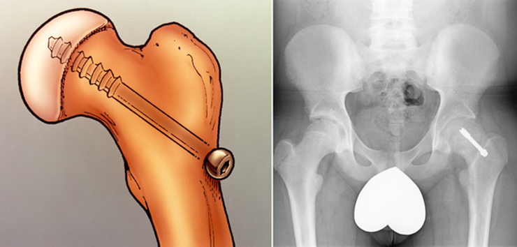 Illustration and x-ray of in situ fixation. A single screw is inserted to prevent any further slip of the femoral head through the growth plate. (Left) Courtesy of John Killian, MD, Birmingham, AL. (Right) Reproduced from Weber MD, Naujoks R, Smith BG: Slipped capital femoral epiphysis. Orthopaedic Knowledge Online Journal 2008; 6(2). Accessed June 2016.